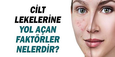 Cilt Lekelerine Yol Açan Faktörler Nelerdir?