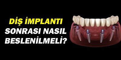 Diş İmplantı Sonrası Nasıl Beslenilmeli?