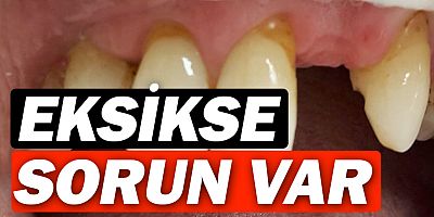 Diş eksikliği birçok hastalığa davetiye çıkarıyor !