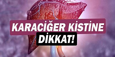  Karaciğer Kistine Dikkat!