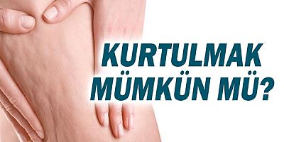 Selüllitlerden kurtulmak mümkün mü?