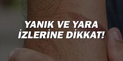 Yanık ve Yara İzlerine Dikkat!