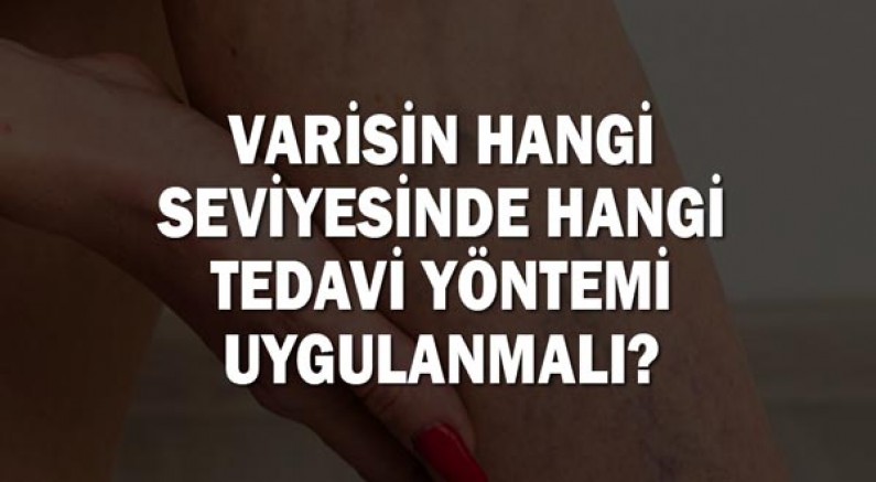 Varisin hangi seviyesinde hangi tedavi yöntemi uygulanmalı?